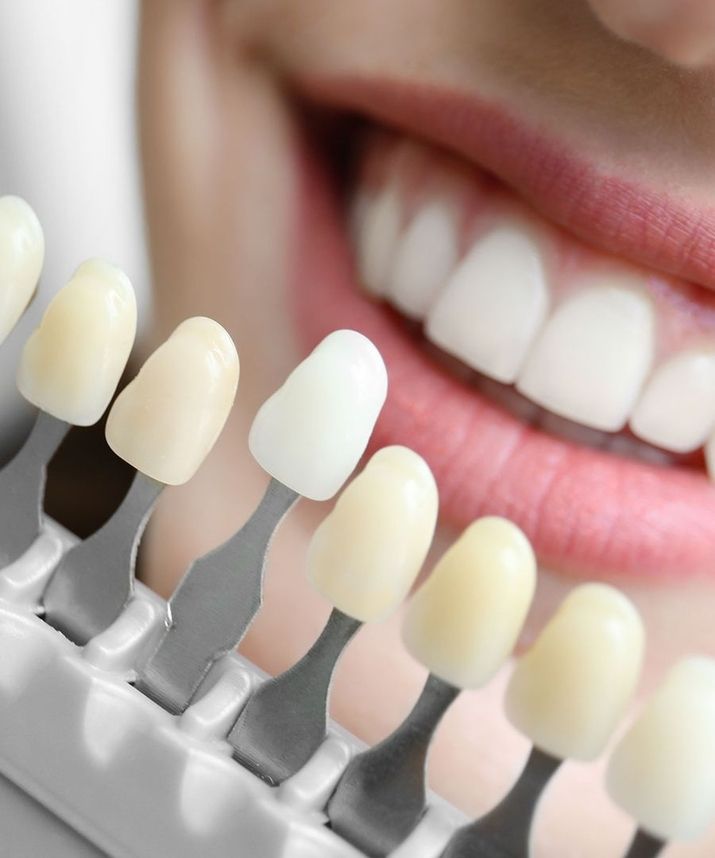 Farbvergleich für Zahnaufhellung mit Zahnfarbskala