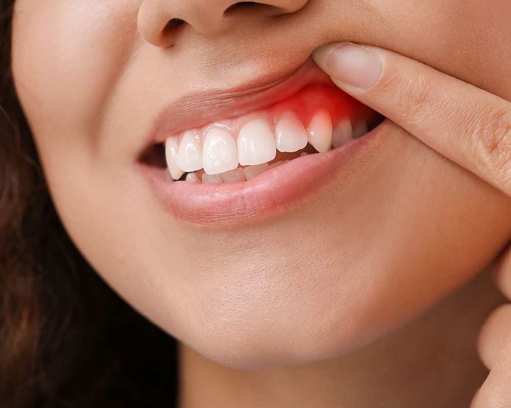 Nahaufnahme eines entzündeten Zahnfleischbereichs mit sichtbarer Rötung