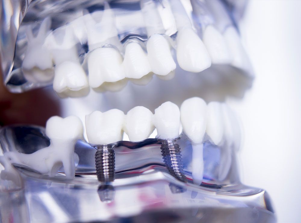 Zahnmodell mit eingesetzten Implantaten und sichtbaren Schrauben