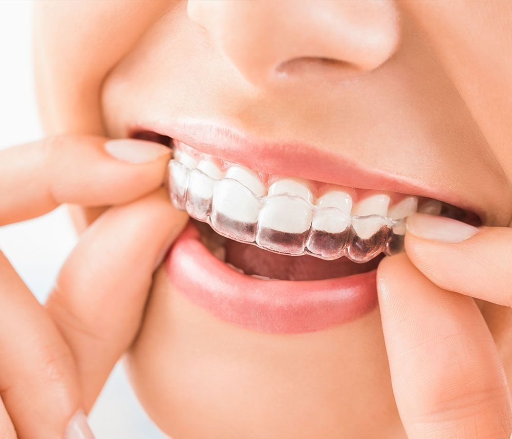 Nahaufnahme einer Frau, die eine transparente Zahnschiene einsetzt
